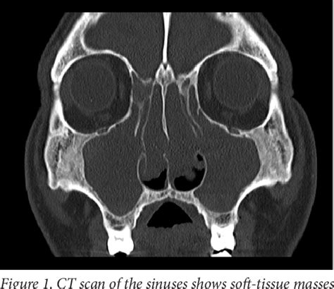 Figure 1 From A Polyp Originating In The Middle Turbinate And Extending To The Maxillary Sinus