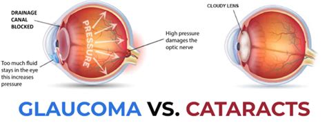 Difference Between Glaucoma And Cataract With Their Symptoms And