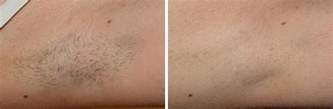 Laser Hair Removal Photos Houston Tx Patient