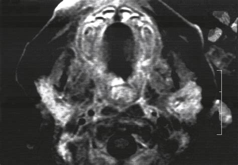 Foregut Duplication Cyst Of The Hypopharynx Clinical Decision Support Jama Otolaryngology