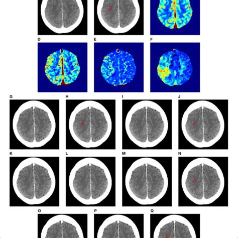 Llustration Of Lesion Segmentation Of Representative Subject Based On Download Scientific