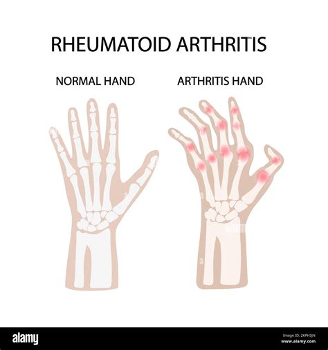 POLYARTHRITE RHUMATOÏDE LÉSIONS des articulations des mains de l homme