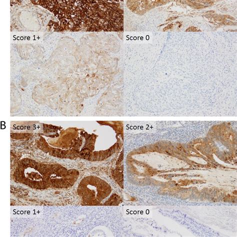 Staining Intensity Patterns For Mesothelin Expression Representative