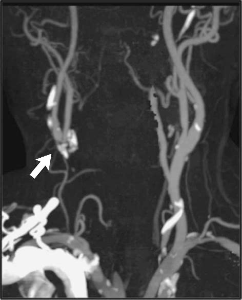 Figure 3 From Riles Type 1a Common Carotid Artery Occlusion Diagnosed By Specific External