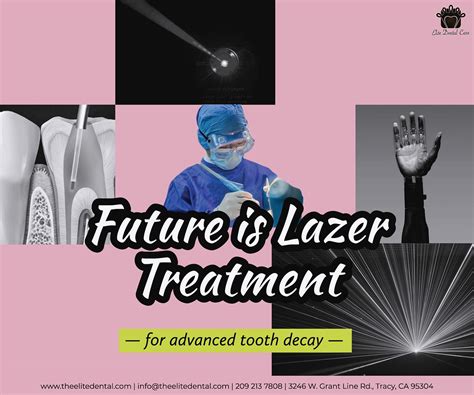 Future Is Laser Treatment For Advanced Tooth Decay Elite Dental Care