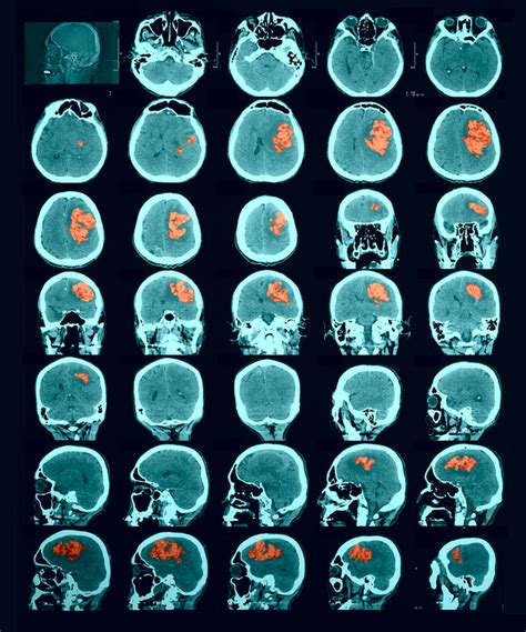 Hemorrhagic Stroke Symptoms, Causes, and Treatment | University Health News