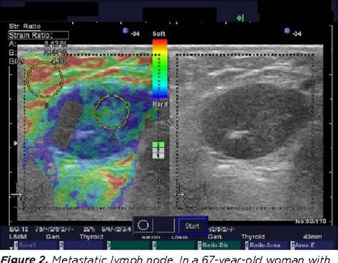 Figure 2 From Differential Diagnosis Of Malignant Cervical Lymph Nodes