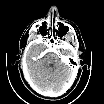 Arachnoid granulation | Radiology Case | Radiopaedia.org