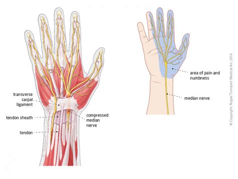 Carpal Tunnel Syndrome Hand Surgery Hand Specialist Montreal