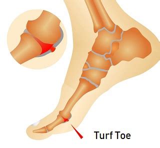 Turf Toe Injury: Causes, Diagnosis & Treatment - Foot Pain Exp