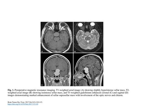 Fig 1 Preoperative Magnetic Resonance Imaging Ppt Download