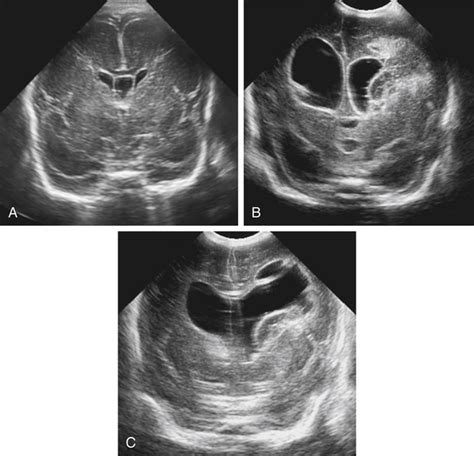 Premature Birth Rule Out Germinal Matrix Hemorrhage Radiology Key