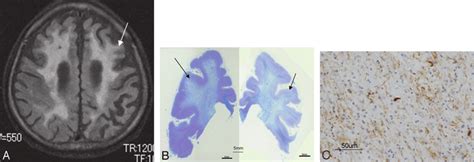 Corticobasal Degeneration Cbd Case 3 A 70 Year Old Man A An Axial Download Scientific