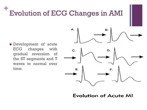 PPT ECG Changes In Myocardial Infarction PowerPoint Presentation ID