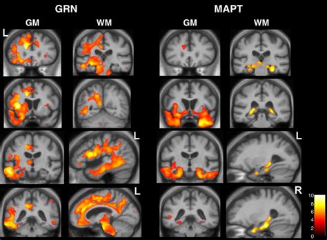 Vbm Analysis On Grey Matter Gm And White Matter Wm Regions In Grn