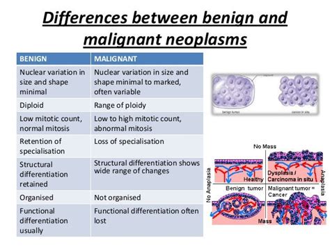 Neoplasia Characteristics And Classification Of Cancer