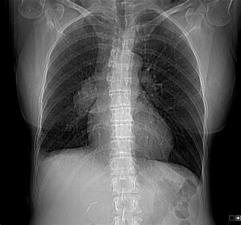 Pulmonary Artery Sarcoma Image Radiopaedia Org