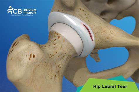 top-5-exercises-for-hip-labral-tear.webp