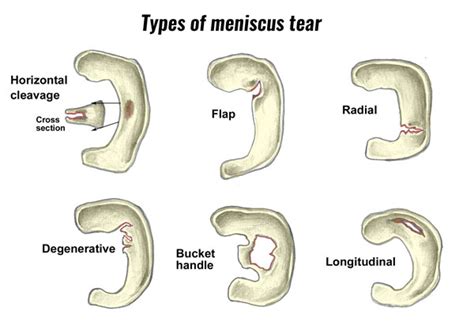 Torn Cartilage Meniscus Symptoms Causes Treatment And Rehabilitation