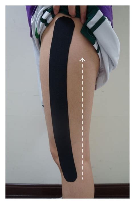 The Applications Of Kinesio Taping For Pfps Patients White Arrow Is