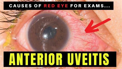 Anterior Uveitis