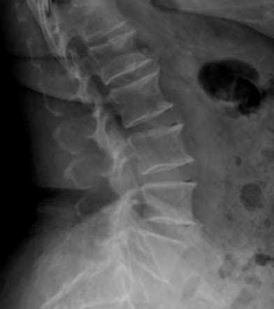 Intervertebral disc vacuum phenomenon | Radiology Case | Radiopaedia.org