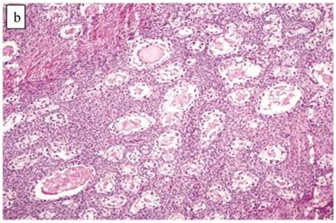 Clear Cell Adenocarcinoma Ovary