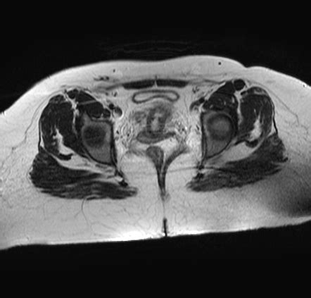 Pelvic Schwannoma Image Radiopaedia Org