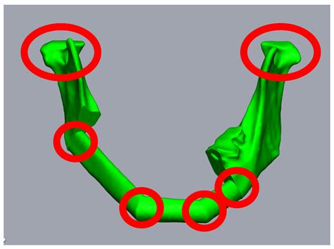 Jpm Free Full Text A Novel Method For Secondary Mandible