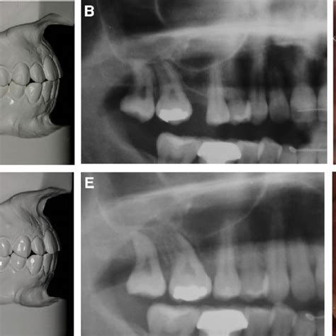 Patient 4 A An Early Maxillary First Molar Extraction And Overerupted Download Scientific