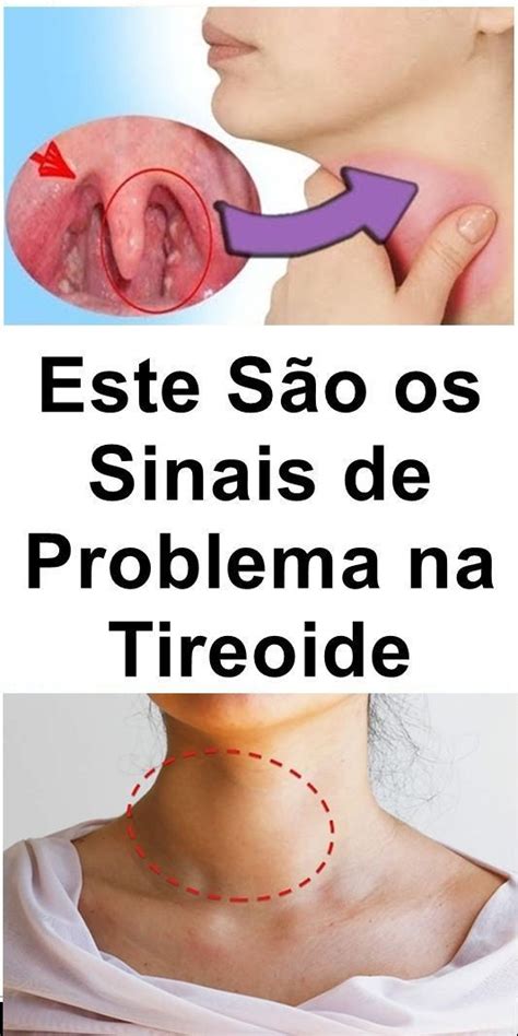 Sinais De Problema Na Tireoide Que Jamais Deve Ignorar Tireoide