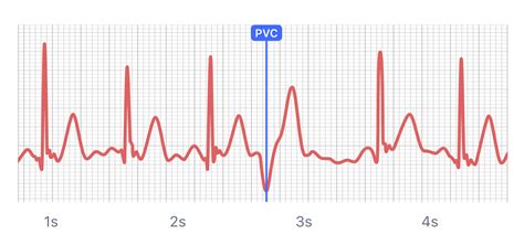 What Premature Ventricular Contraction (PVC) Looks Like On, 44% OFF