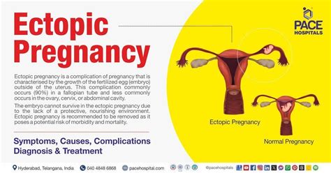 Ectopic Pregnancy Causes Symptoms Types And Treatment