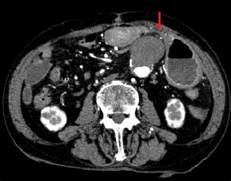 Abdominal aortic aneurysm looked like compression of the antrum of the... | Download Scientific ...