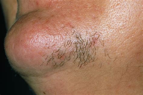 Red Flag Symptoms Hirsutism Gponline