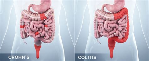 INFLAMMATION Crohn S Disease And Ulcerative Colitis UC