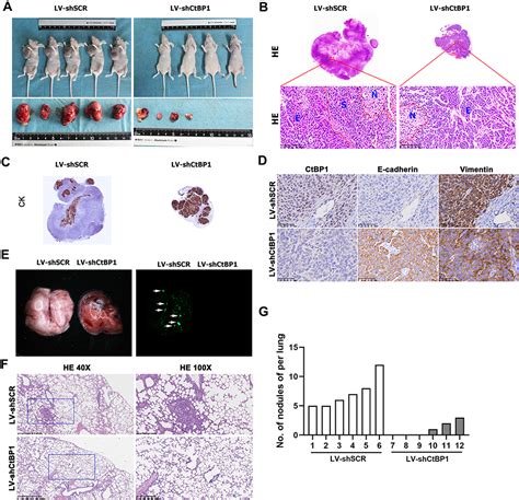 Ctbp1 Mediated Hypoxia Induced Sarcomatoid Transformation Jhc