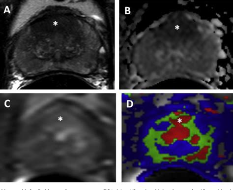 Figure 1 From Current Ability Of Multiparametric Prostate Magnetic