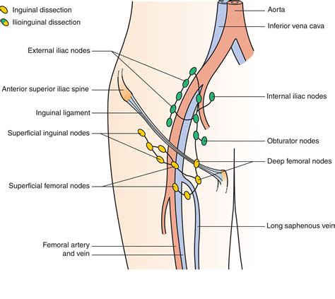 Optimal Extent Of Completion Lymphadenectomy For Patients With Melanoma