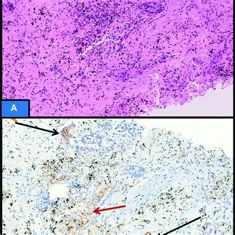 Hematoxylin And Eosin Section Showing Non Small Cell Lung Carcinoma Download Scientific Diagram