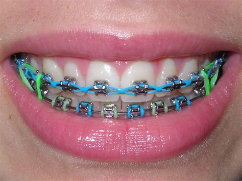 √ Braces Colors Combinations