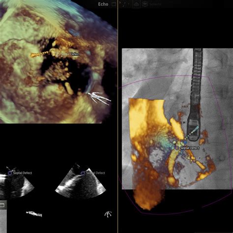 Fusion Of 3 Dimensional Echocardiography And Fluoroscopy Using