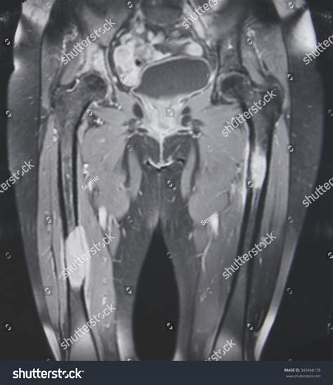 Metastatic Tumors Femur Mri Stock Photo 343468178 | Shutterstock