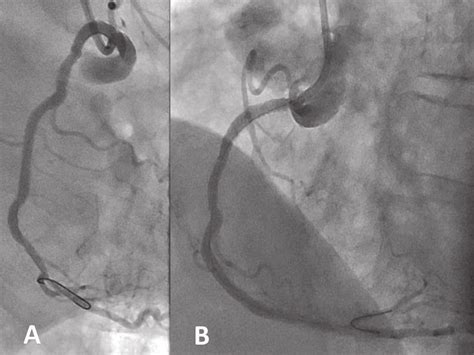 Appearance Of The Aortic Dissection Starting From The Rca Ostium And