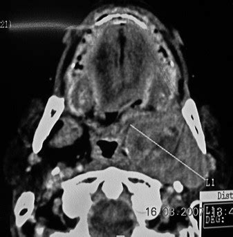 Clinical Pathologic Conference Case A Diffuse Swelling Affecting