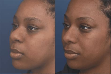 Black Rhinoplasty Before And After