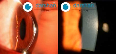 Keratoconus Is A Type Of Corneal Ectasia Darshan Eye Care