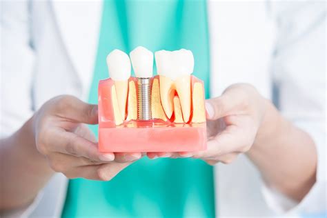 Cuál es la duración de los implantes dentales C M Odontología