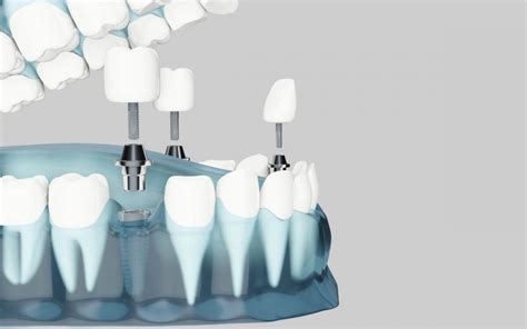 Posibles Complicaciones De Los Implantes Dentales Veracruz Dental