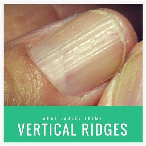 Nails Health Signs Lines In Nails Health Signs In 2020 Vertical